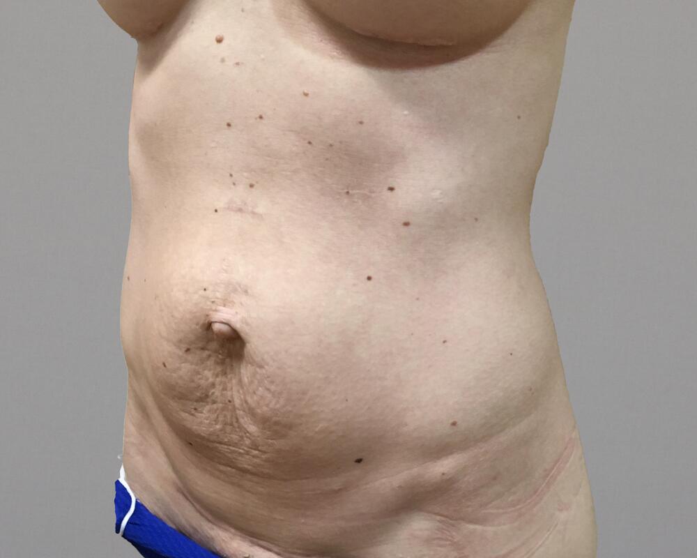 Tummy Tuck Before & After Image