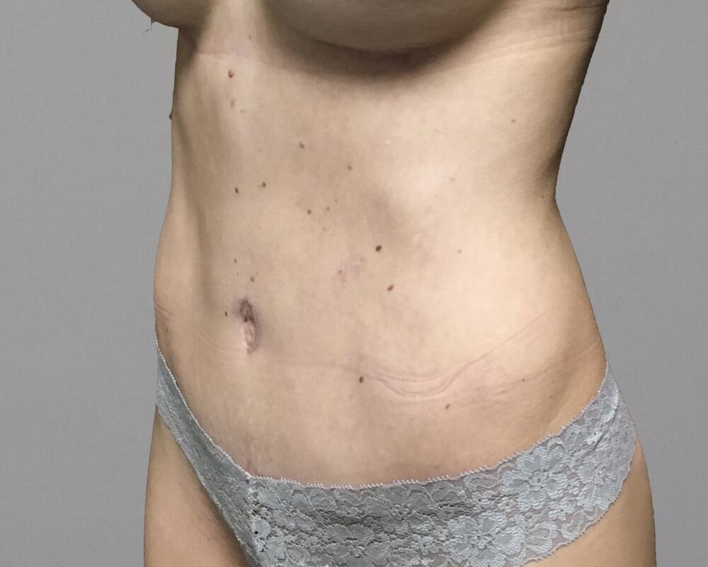 Tummy Tuck Before & After Image