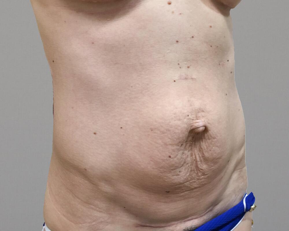 Tummy Tuck Before & After Image