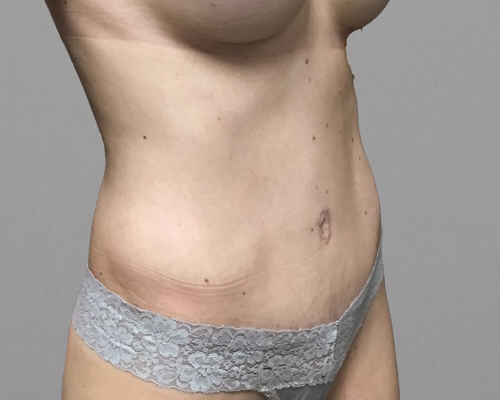 Tummy Tuck Before & After Image