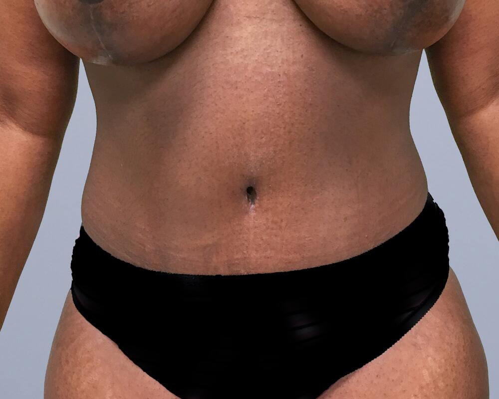 Tummy Tuck Before & After Image