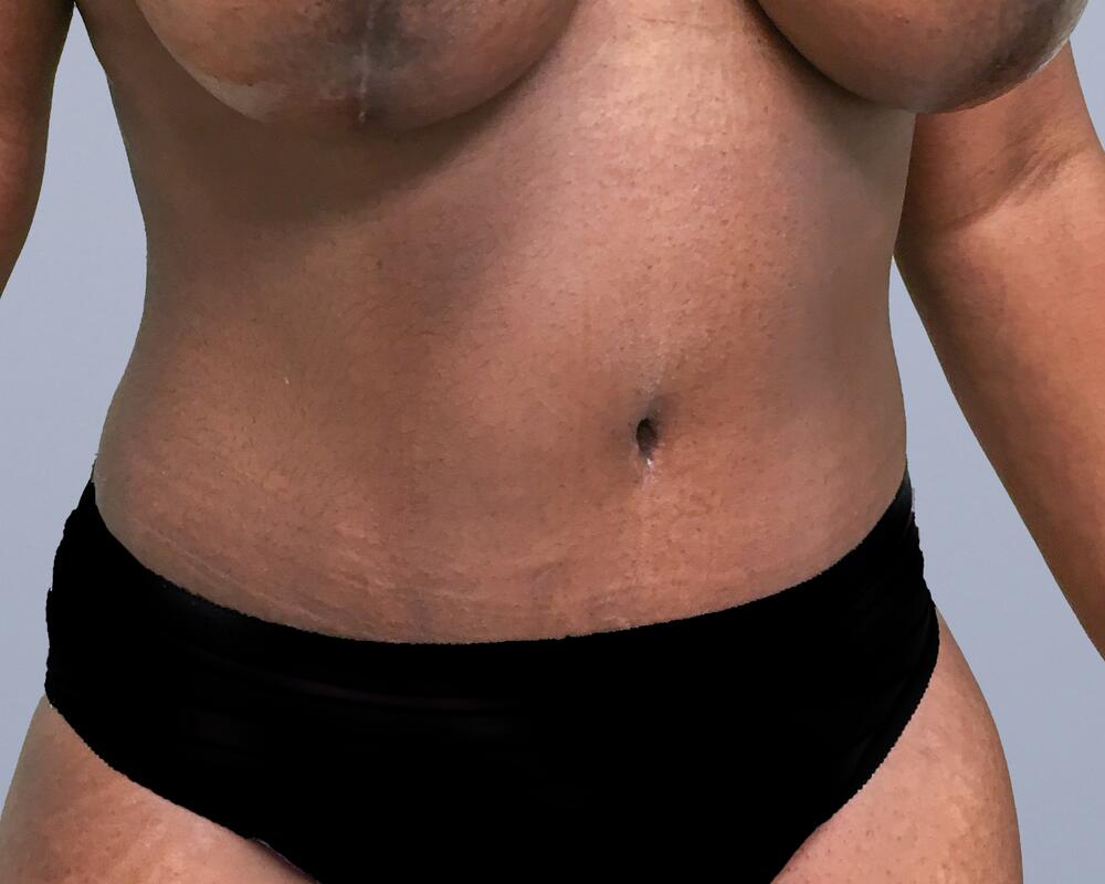 Tummy Tuck Before & After Image