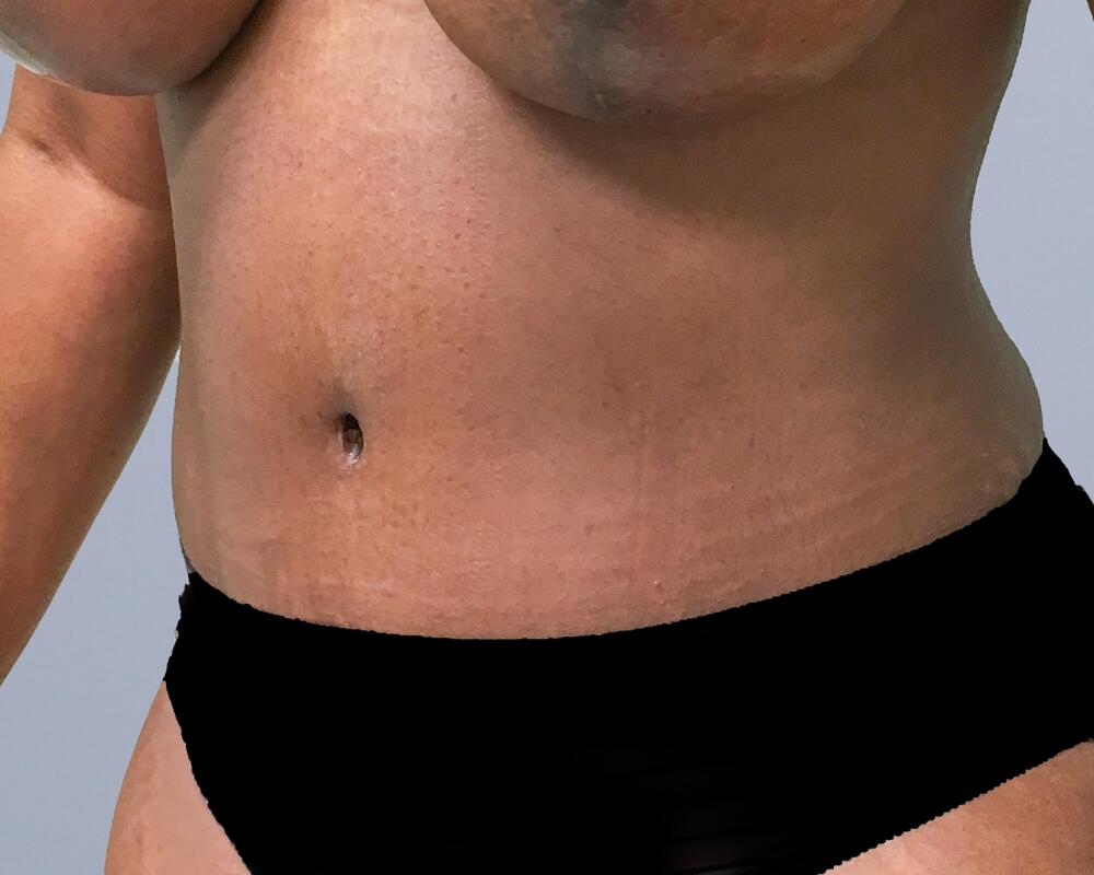 Tummy Tuck Before & After Image