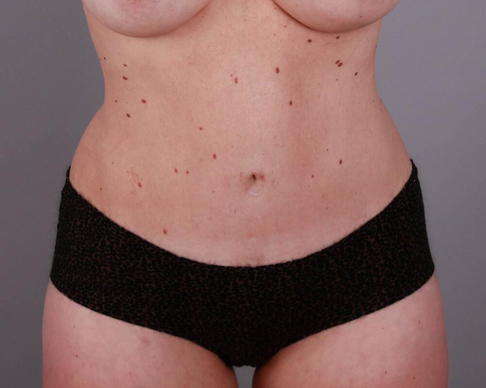 Tummy Tuck Before & After Image