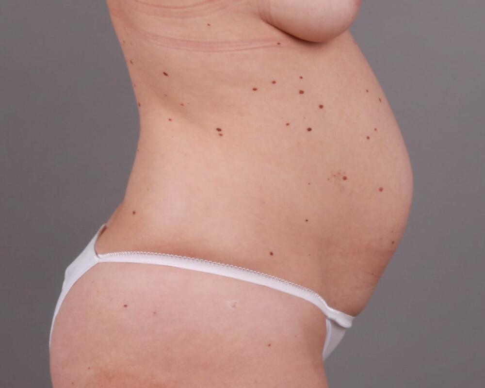 Tummy Tuck Before & After Image