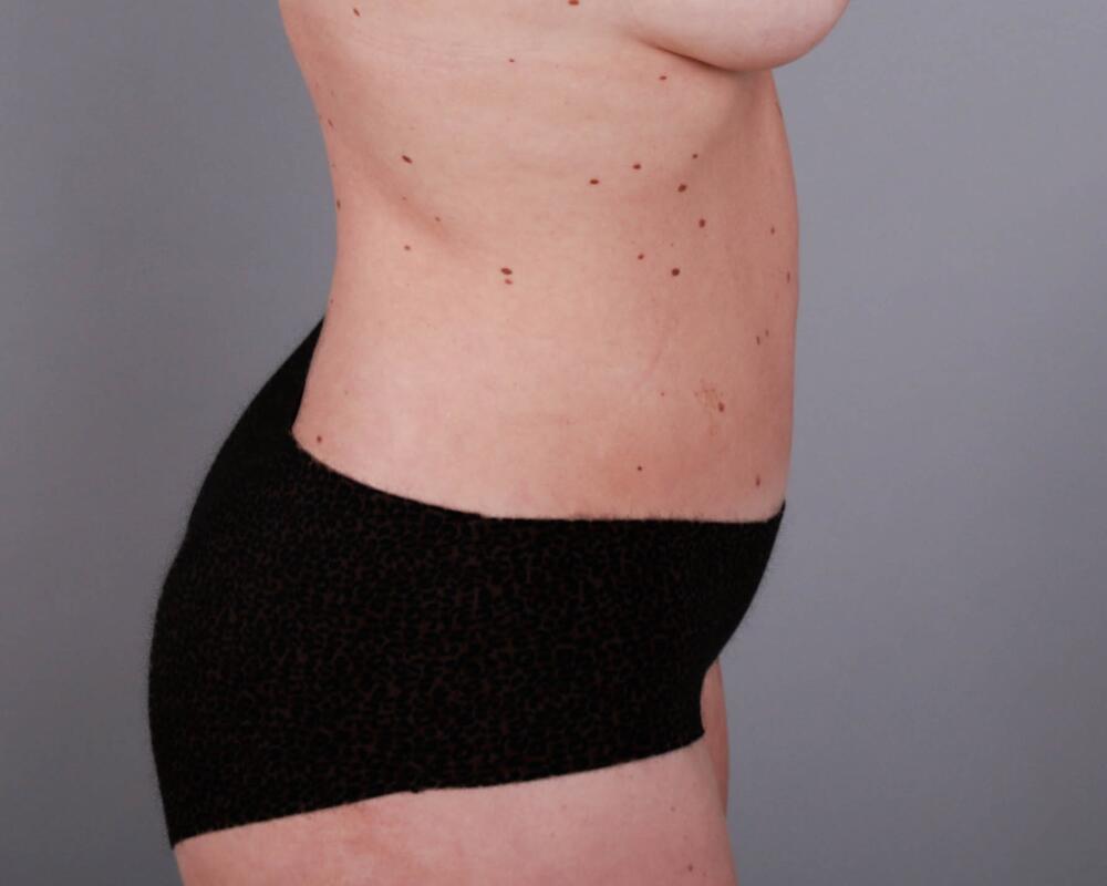 Tummy Tuck Before & After Image