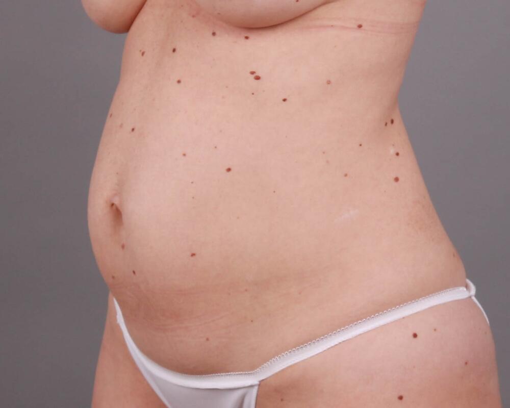 Tummy Tuck Before & After Image