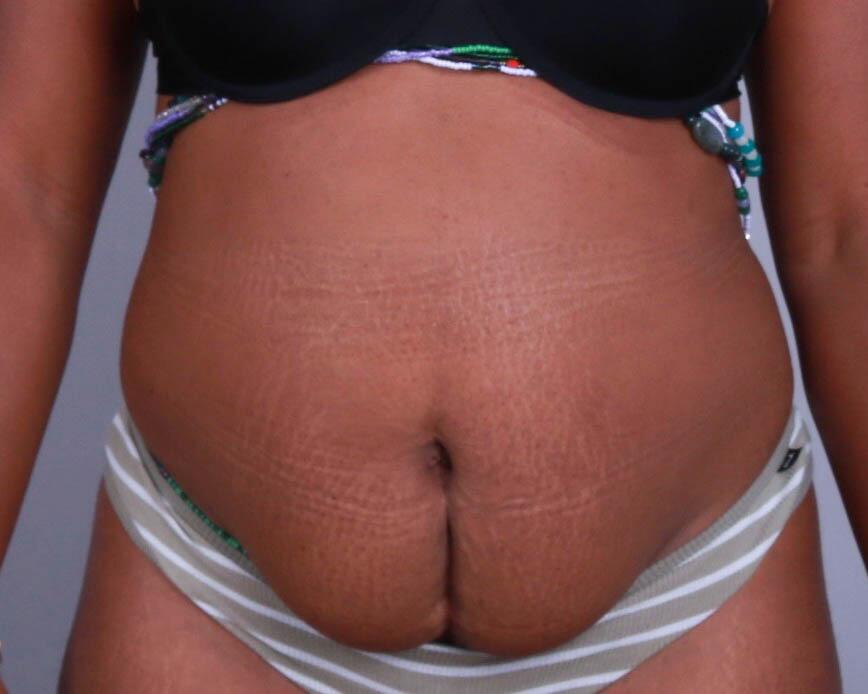 Tummy Tuck Before & After Image