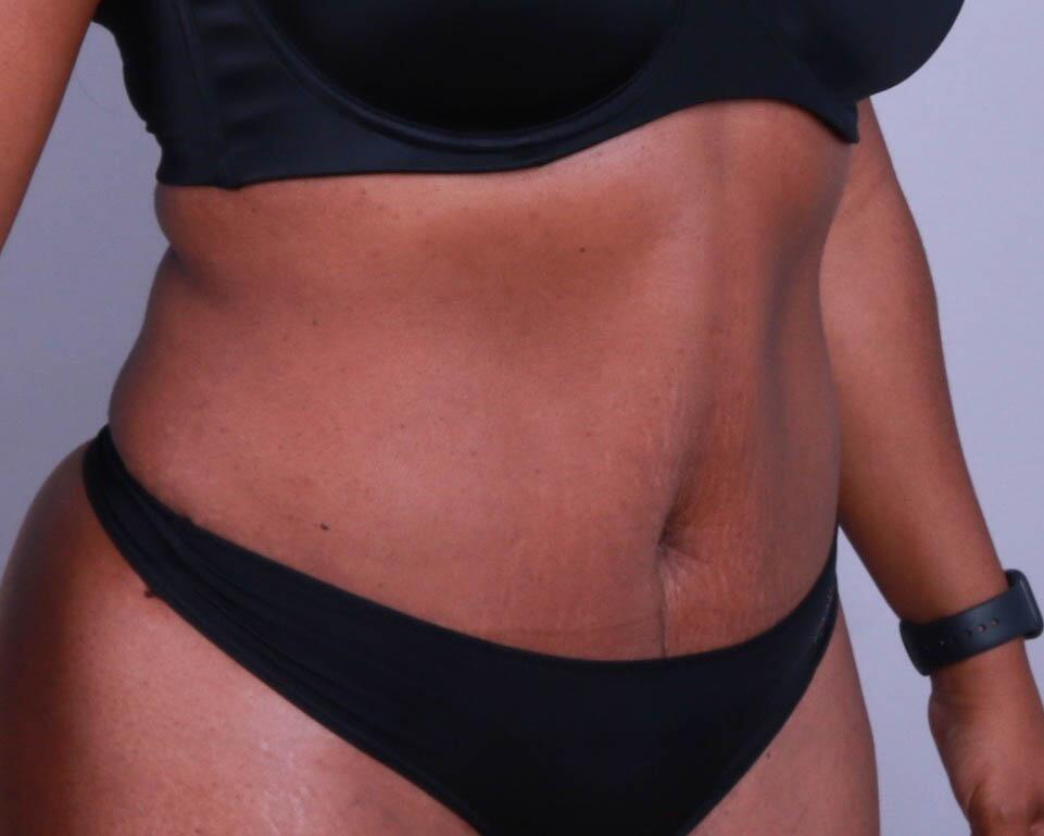 Tummy Tuck Before & After Image