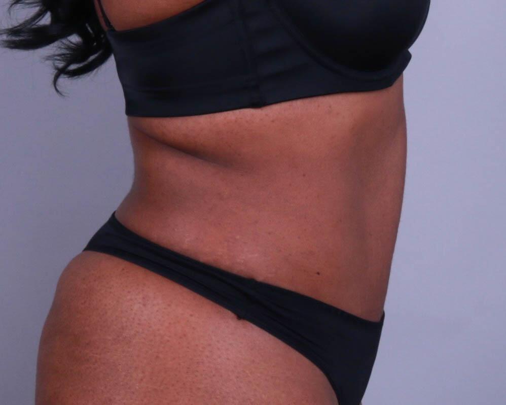 Tummy Tuck Before & After Image