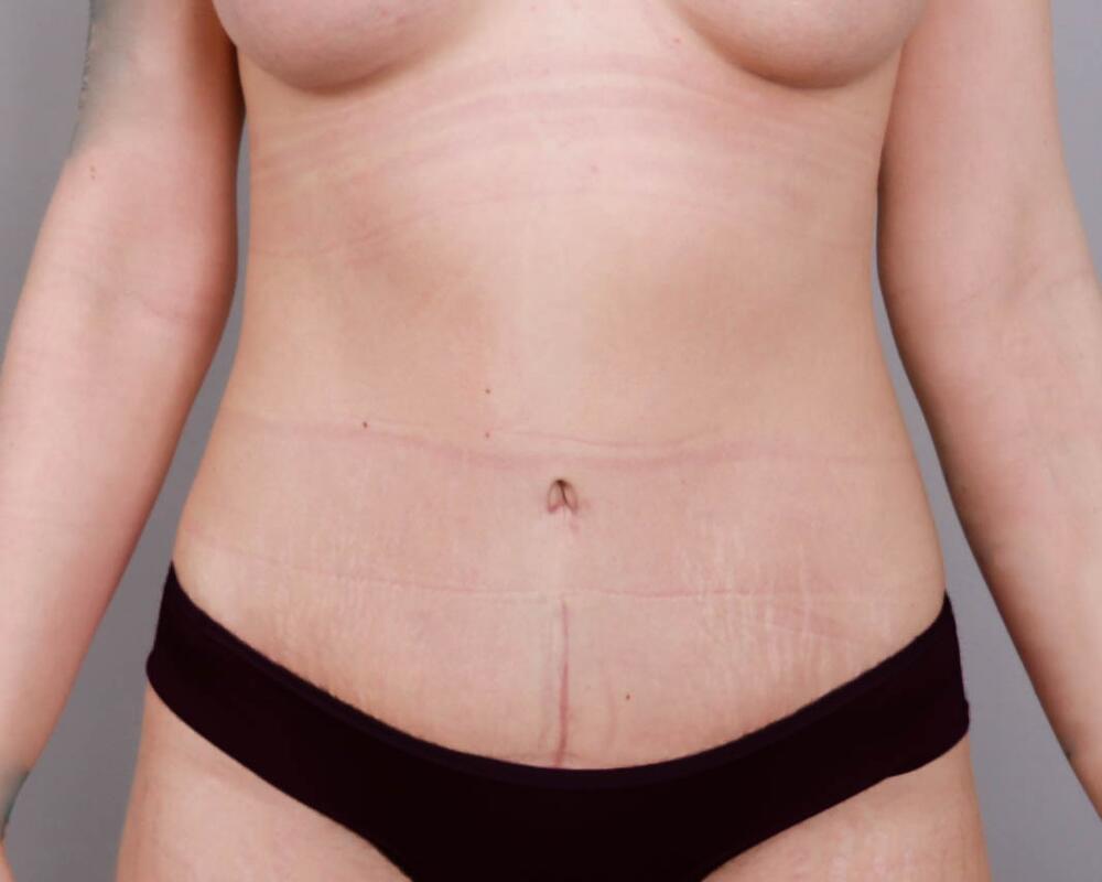 Tummy Tuck Before & After Image