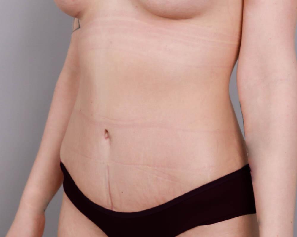 Tummy Tuck Before & After Image