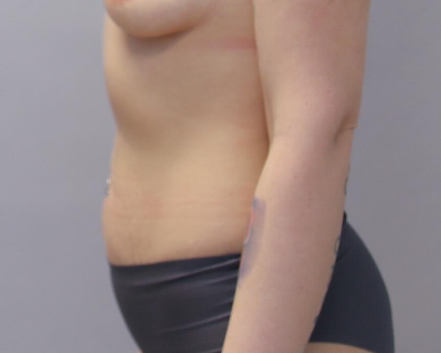 Tummy Tuck Before & After Image