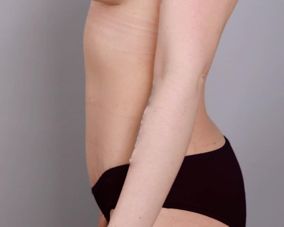 Tummy Tuck Before & After Image