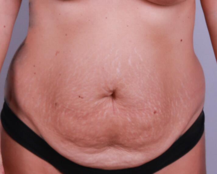 Tummy Tuck Before & After Image