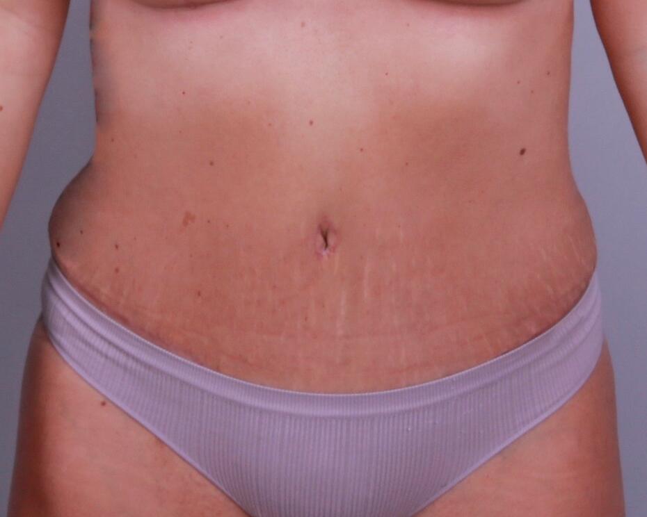 Tummy Tuck Before & After Image