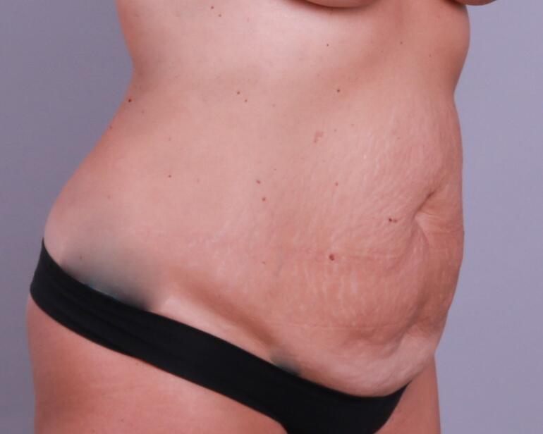 Tummy Tuck Before & After Image