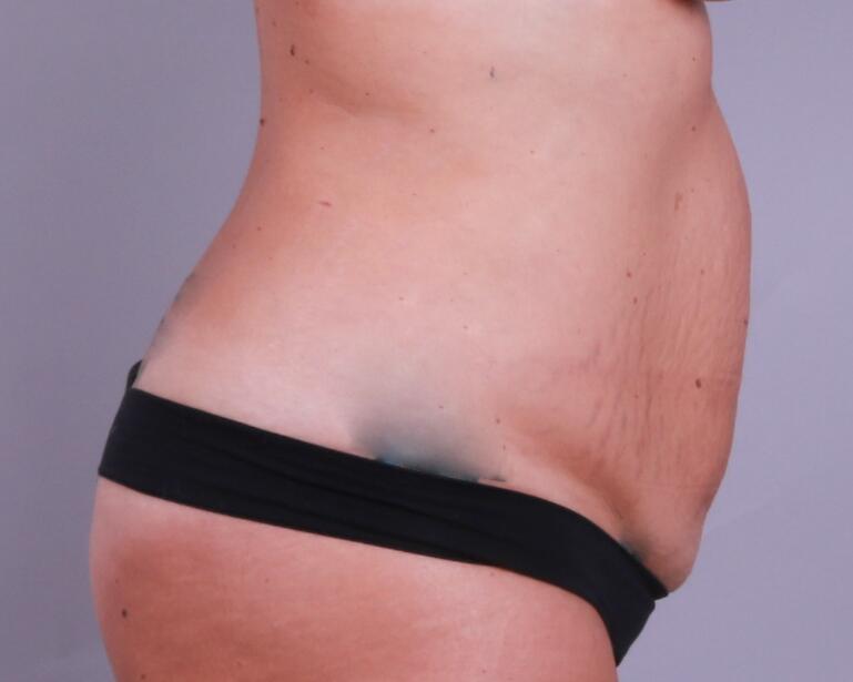 Tummy Tuck Before & After Image