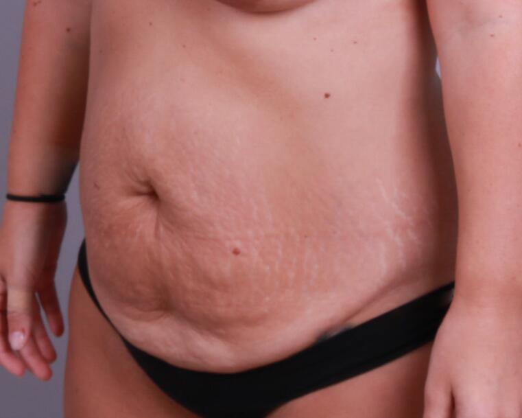 Tummy Tuck Before & After Image