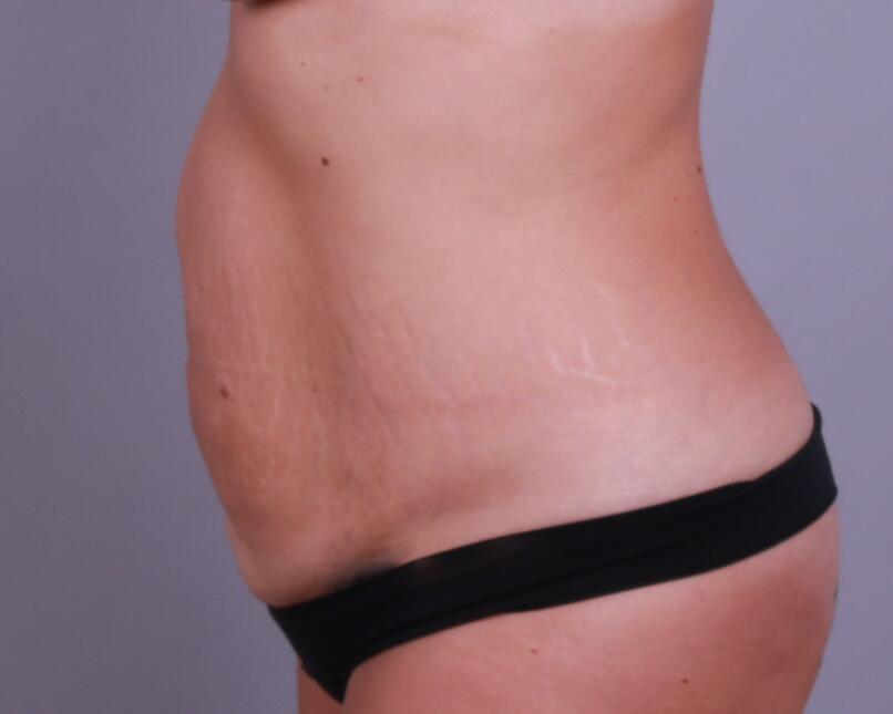 Tummy Tuck Before & After Image