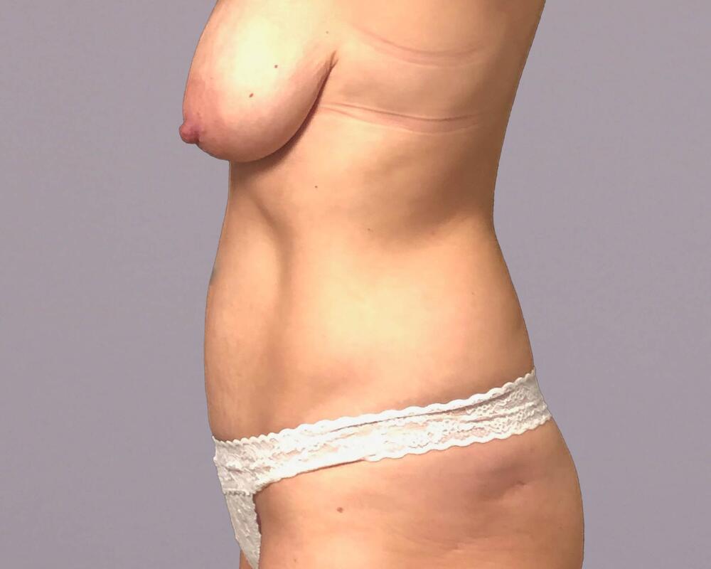 Tummy Tuck Before & After Image