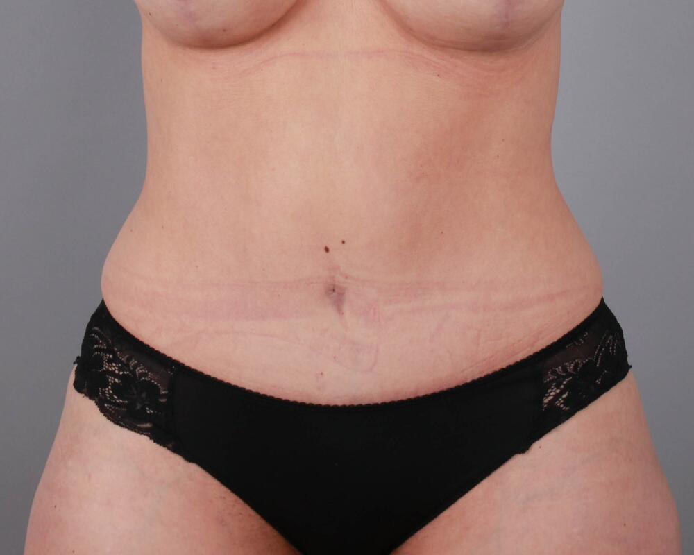 Tummy Tuck Before & After Image