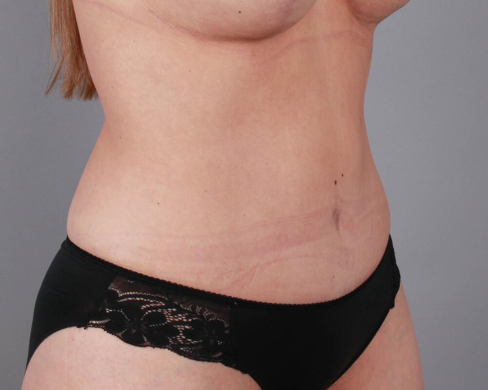 Tummy Tuck Before & After Image