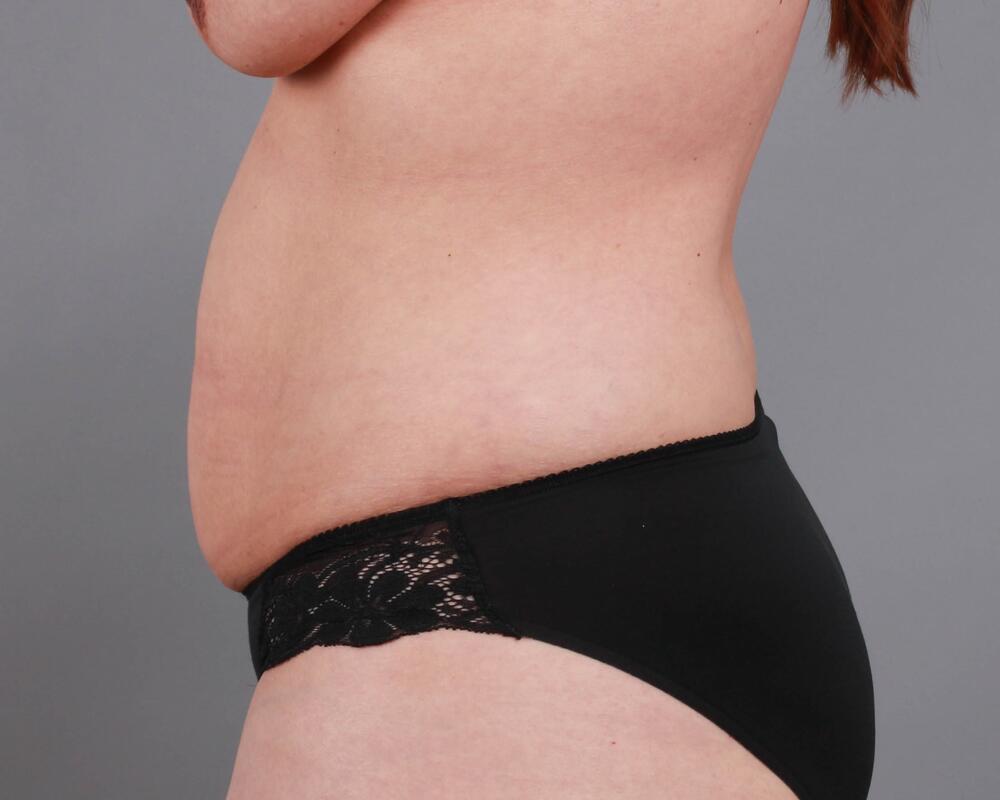 Tummy Tuck Before & After Image