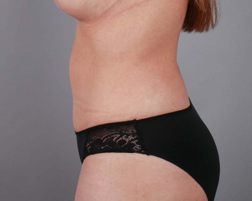 Tummy Tuck Before & After Image