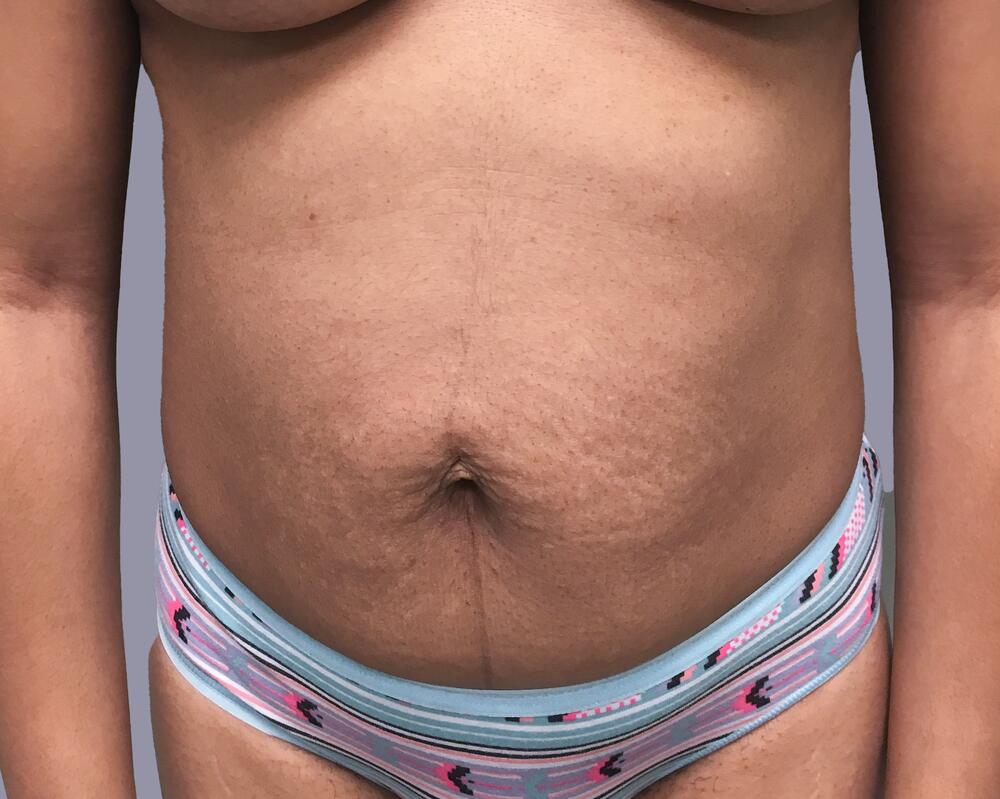 Tummy Tuck Before & After Image