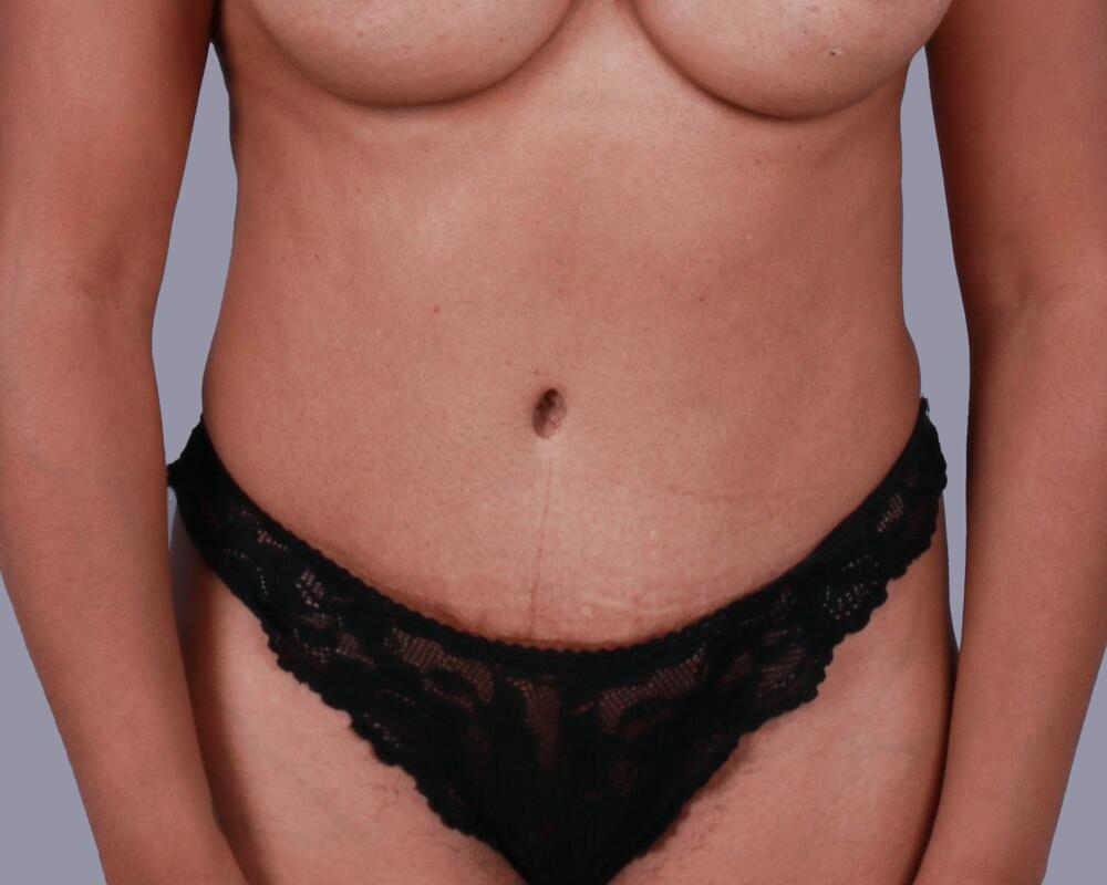 Tummy Tuck Before & After Image