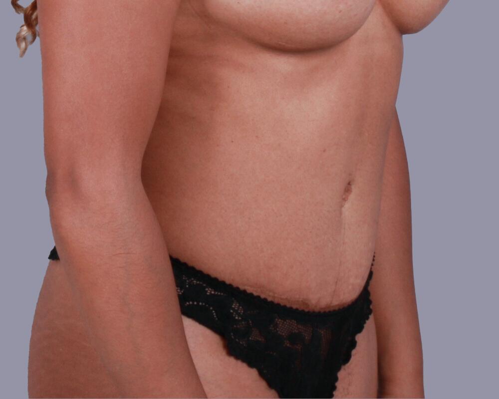 Tummy Tuck Before & After Image