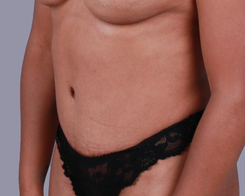 Tummy Tuck Before & After Image