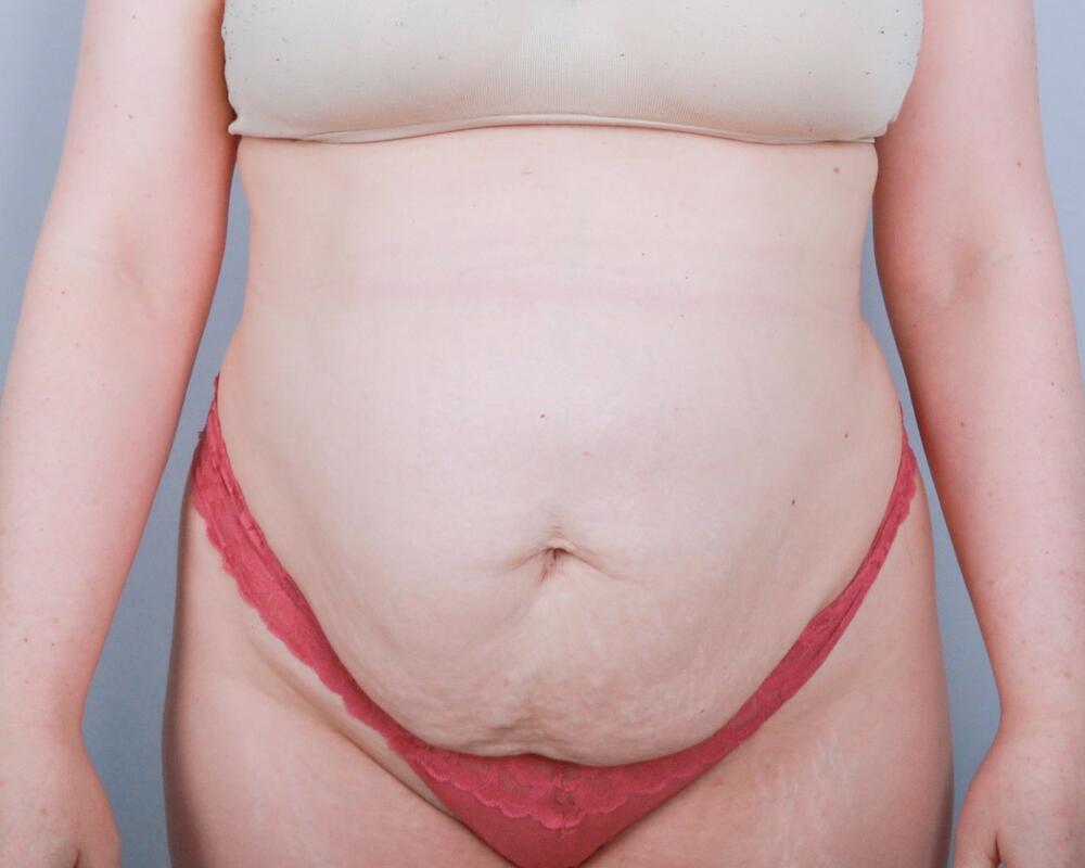 Tummy Tuck Before & After Image