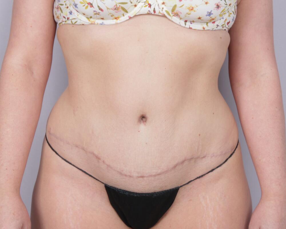 Tummy Tuck Before & After Image