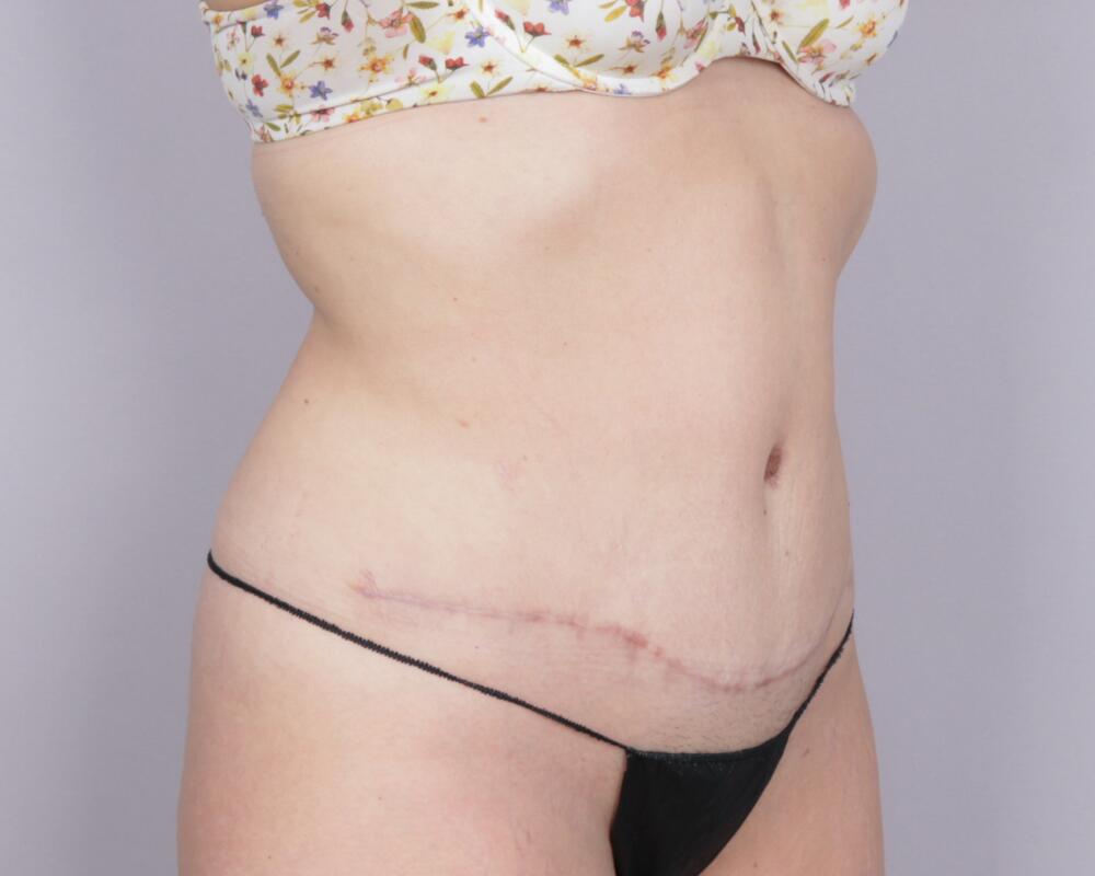 Tummy Tuck Before & After Image