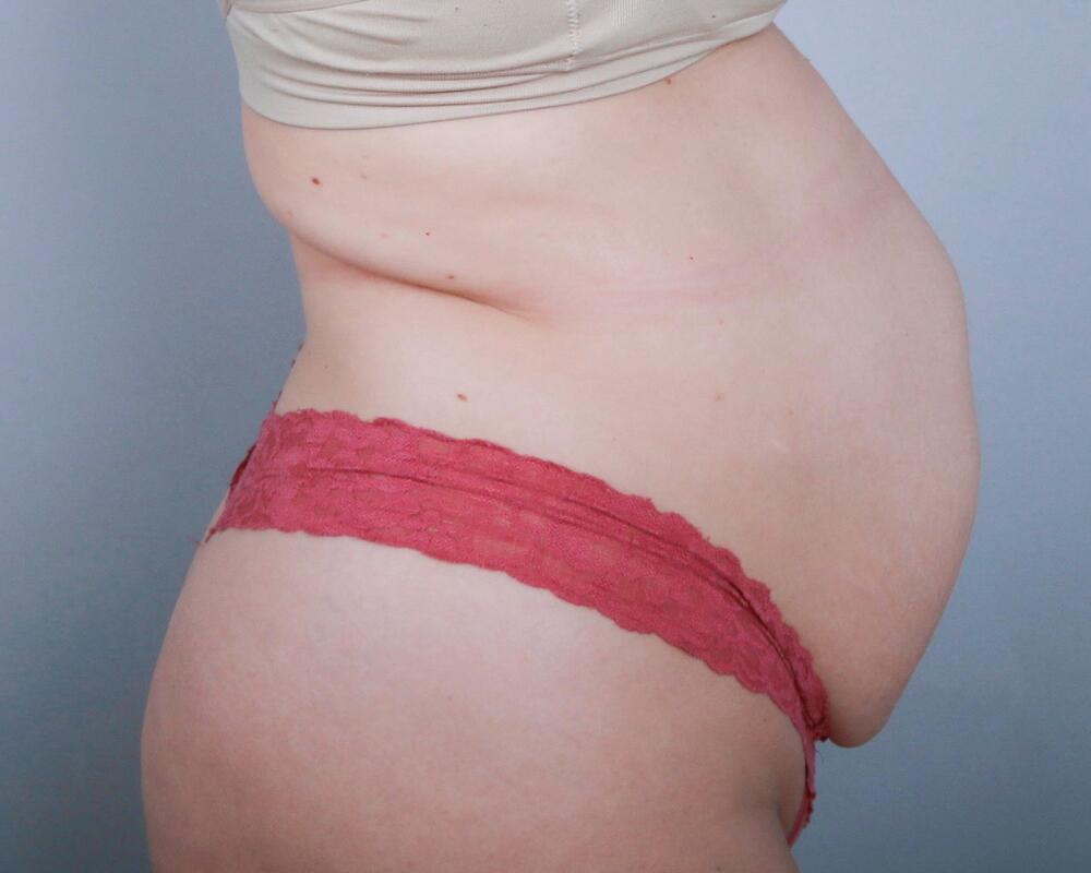 Tummy Tuck Before & After Image