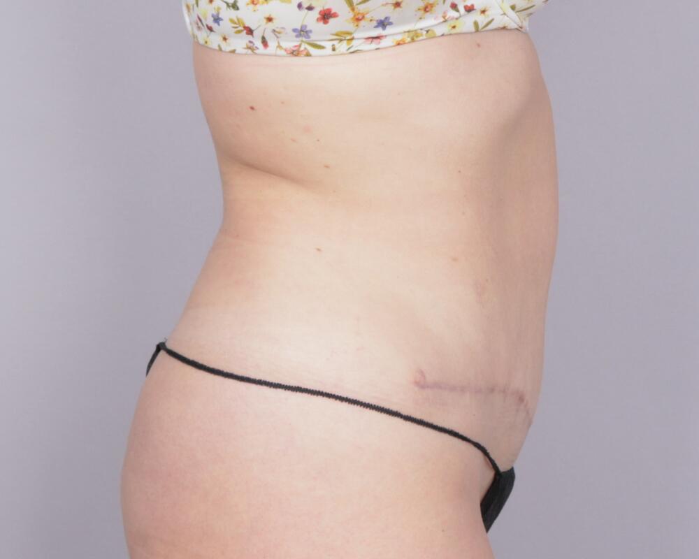 Tummy Tuck Before & After Image