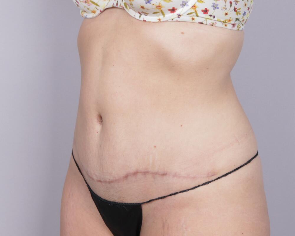 Tummy Tuck Before & After Image