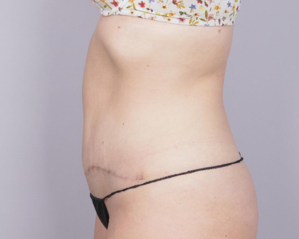 Tummy Tuck Before & After Image