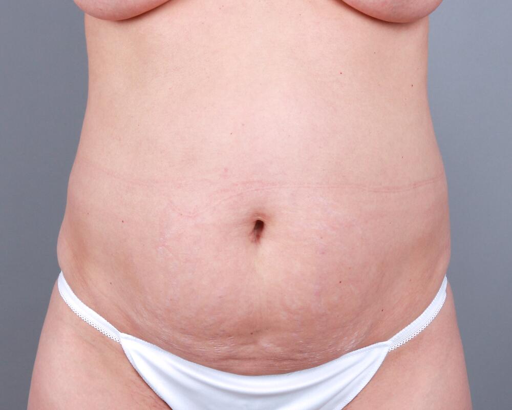 Tummy Tuck Before & After Image