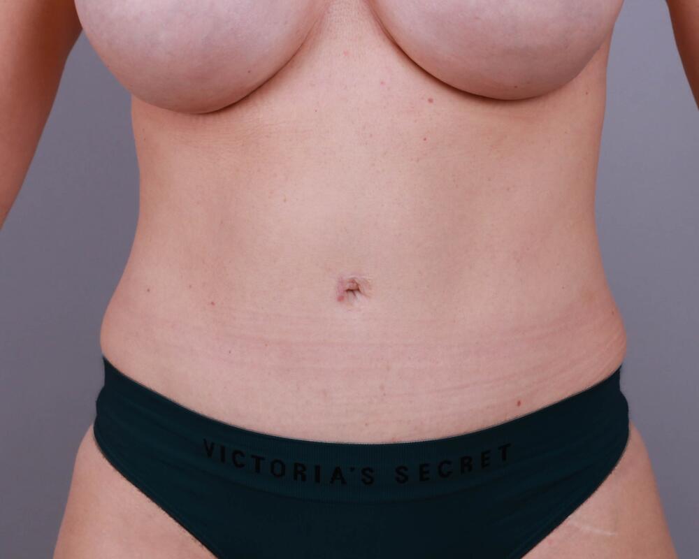 Tummy Tuck Before & After Image