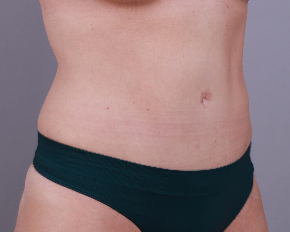 Tummy Tuck Before & After Image