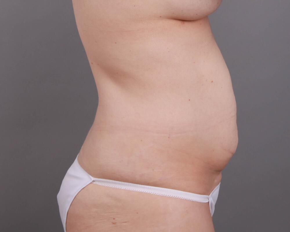 Tummy Tuck Before & After Image