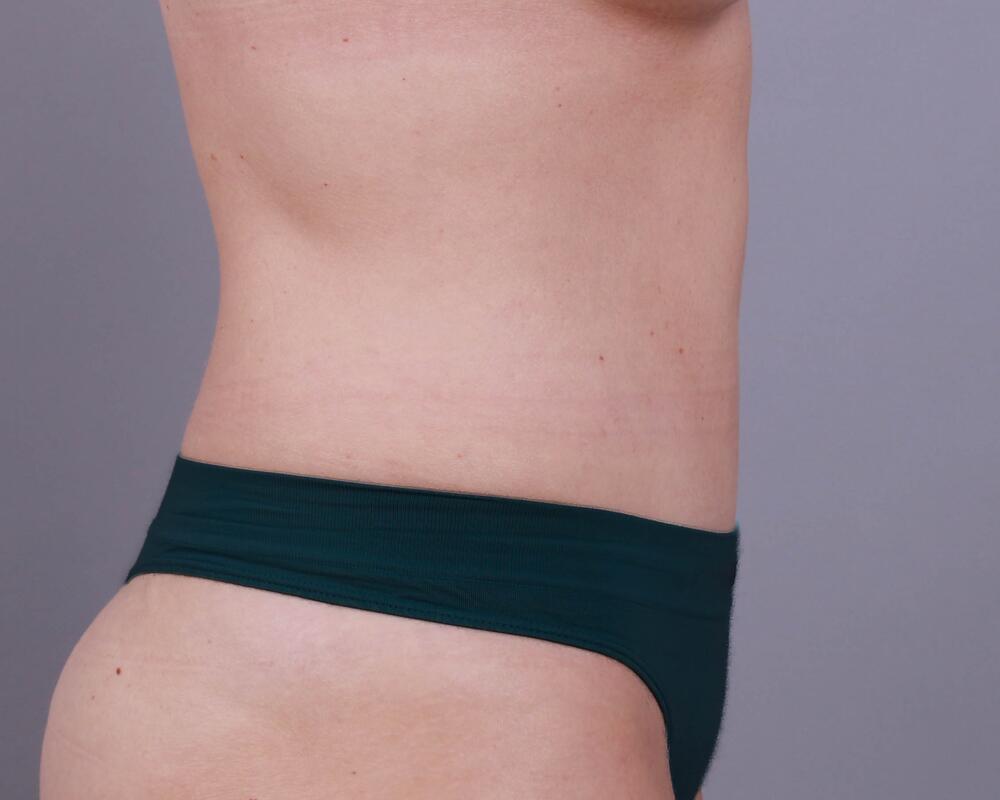 Tummy Tuck Before & After Image