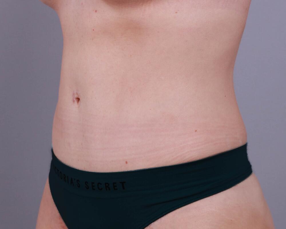 Tummy Tuck Before & After Image