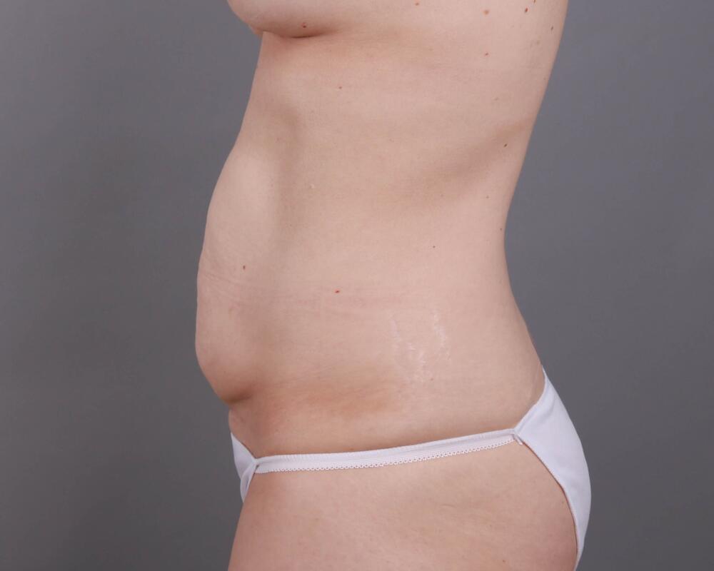 Tummy Tuck Before & After Image