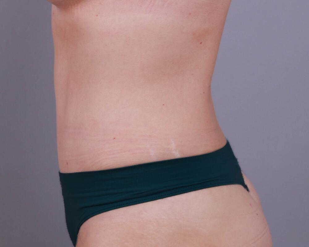 Tummy Tuck Before & After Image