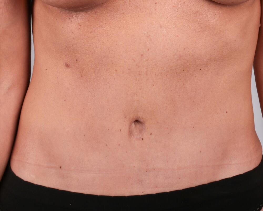 Tummy Tuck Before & After Image