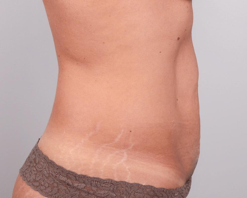 Tummy Tuck Before & After Image